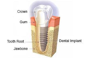 dental implant magodo