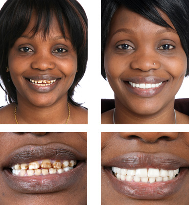 Dental Veneers Lagos